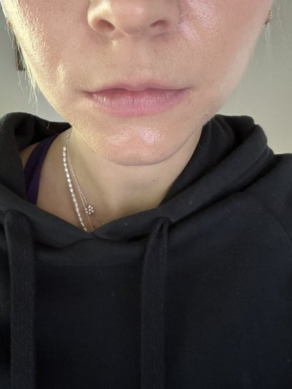 Would lip filler achieve a natural and more symmetrical look photos