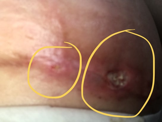 small hole on my chest : r/woundcare