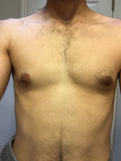 I'm a 19 year old male. Do I have puffy nipples/gynecomastia? (Photo)