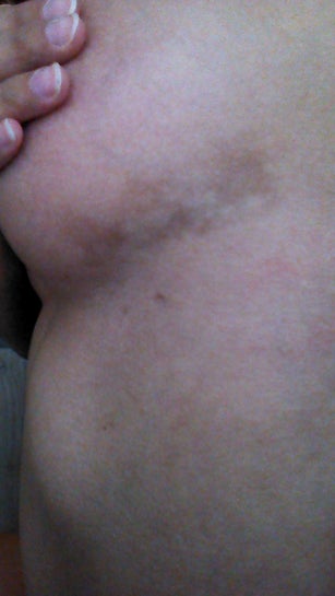 Dark spots on my lower part of breast