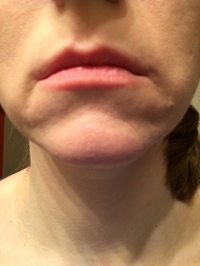 What is causing this bulge below my lips and what treatment would