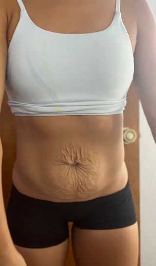 Would I benefit from a reverse tummy tuck and are there any non surgical  alternatives to this procedure? (photos)