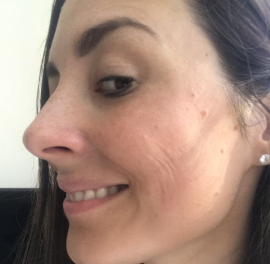 Cheek Wrinkles When Smiling: Proven Tips to Smooth and Prevent