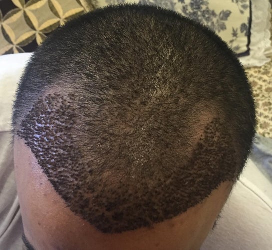 How Can I Get Rid Of Hair Transplant Scabs?, 41% OFF