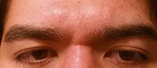 horizontal wrinkle between eyes