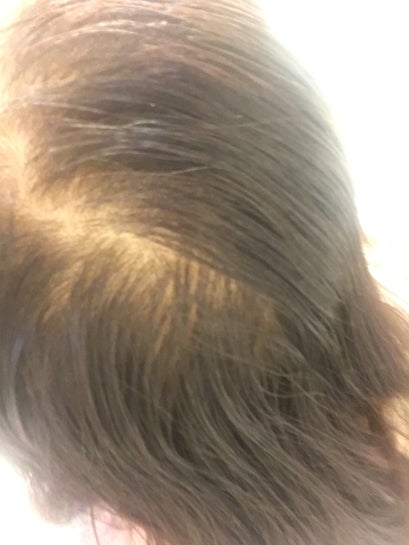 My Hair Is Thinning With Very Shiny Scalp And Vellus Hair All Over My Scalp That Seems To Be Almost Colorless Photos