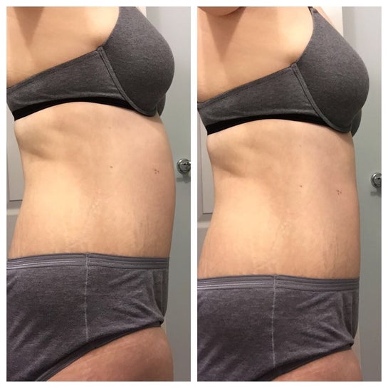 Upper abdominal swelling after Tummy Tuck. Is 7 weeks too early to see this  type of swelling? (Photo)