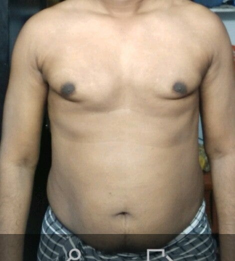 Why Do I Have Indents On My Chest After Gynecomastia Surgery Photos