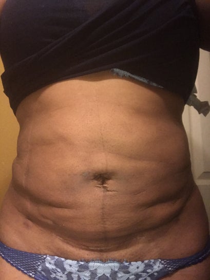 Is Lumps Dents And Uneven Skin Normal After 11 Weeks Liposuction Photos