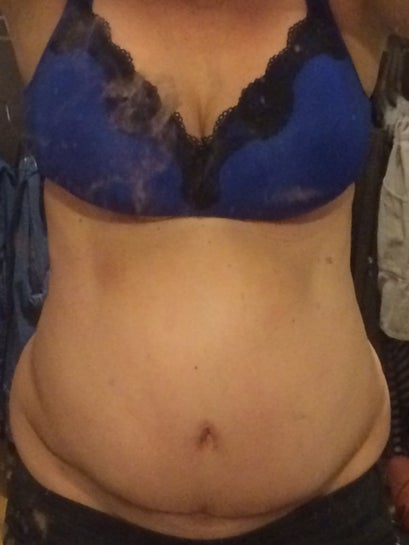 Should I still be this swollen 9 weeks after a full Tummy Tuck with muscles  tightened? (photo)