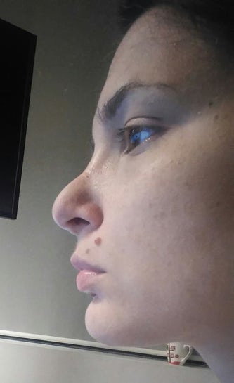 1 Year After Rhinoplasty I Think I Have Pollybeak Shall I Try Kenalog Injection Photo
