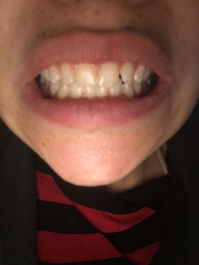 Can My One Crooked Tooth Be Fixed With A Retainer Photos
