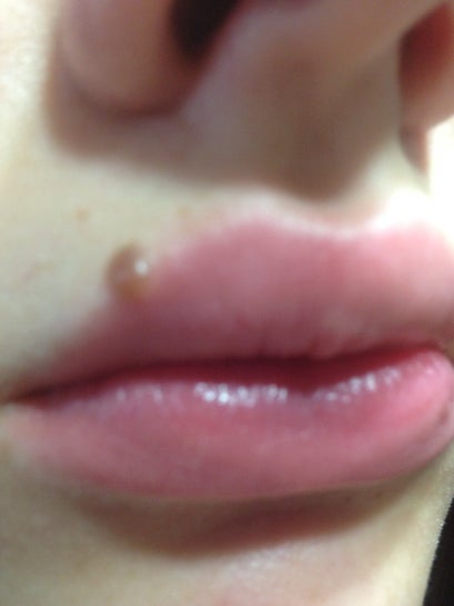 labial melanotic macule removal cost LABIAL LENTIGO Lentigo also called a labial macule, is a harmless, small, flat, brown spot on the lip. It can develop after repeated sun exposure. In most cases, labial lentigo How much would it cost