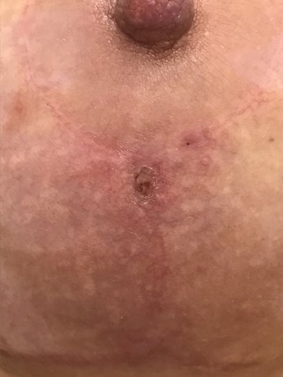 Symmastia 3 months post op? Surgeon says no but cleavage is scary looking  and skin is pulled off the chest.Will they get better?