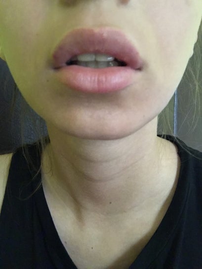 Lumps In Lips From Filler Lipstutorial