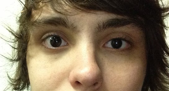 My Eyes Are Completely Different Size, Shape, Vision? (photo)