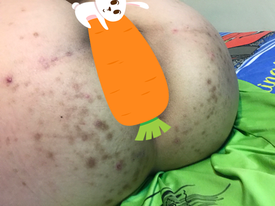 Why Do I Get Pimples On My Buttcheek