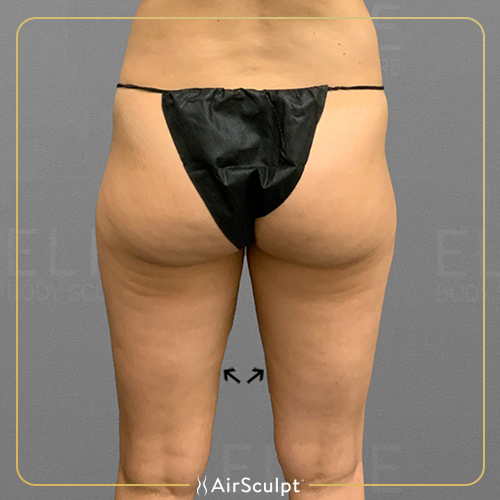 Dallas Natives, Lose Belly Fat and Treat Yourself to a Brand New AirSculpt®  Tummy