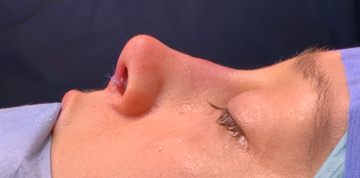 Rhinoplasty London London Realself The specialist surgeons at the london clinic perform rhinoplasty under general anaesthetic. rhinoplasty london london realself