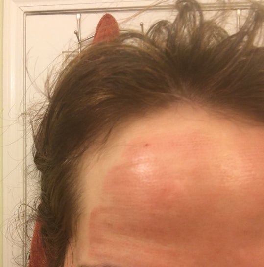 Skinfinity Rf 5 Weeks Ago Are Track Marks And Pigmentation Permanent Photos Skinfinity specializes in relaxing, customized facials, skin correction and industry leading eyelash services & eyebrow shaping.