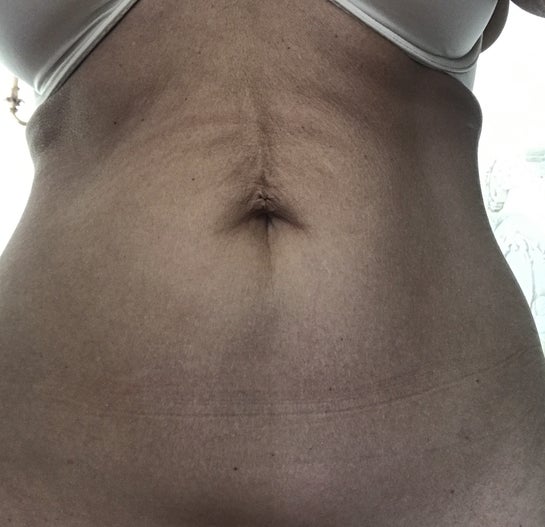 Is a reverse tummy tuck the right procedure for my loose upper abdominal  skin? (Photos)