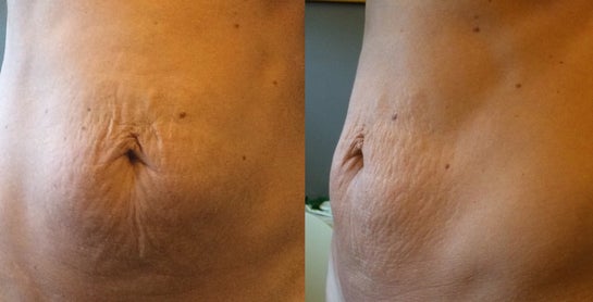 Treatment for crepey abdominal skin : r/30PlusSkinCare