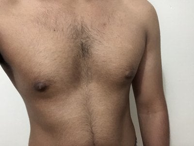 Is this gynecomastia: My nipples are puffy and point outwards. I