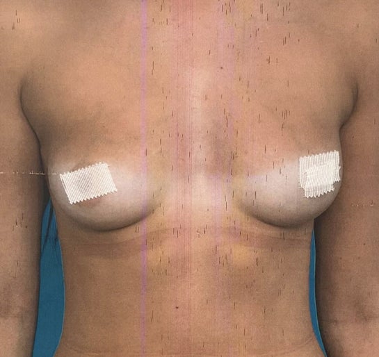 Symmastia breast implant displacement (uni-boob) problems
