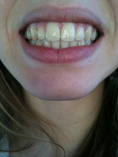 How Can I Fix My Big Front Teeth