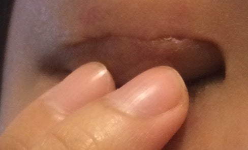 Dissolvable Stitch Poking Out Of Crease Photo