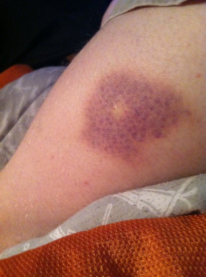 What S Up With This Bruise Photo