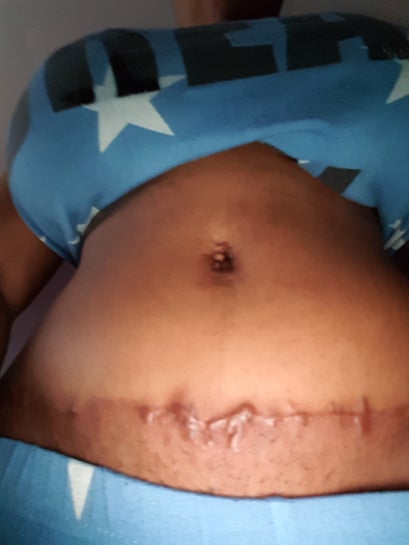 waist trainer after tummy tuck