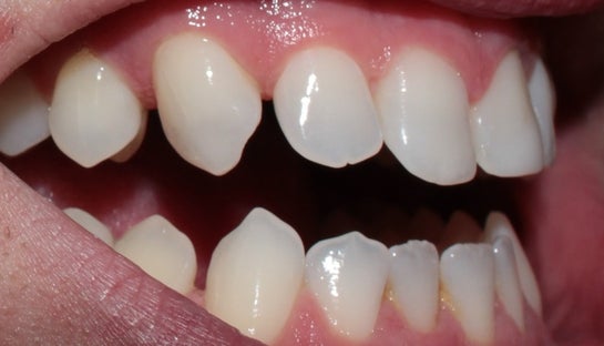 Stunning The Gap Where A Large Canine Tooth Can Rest Background Photography