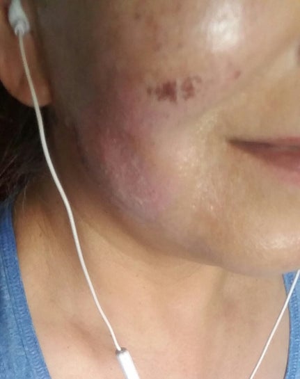 Can my laser burn scar be cleared with more BBL laser treatments