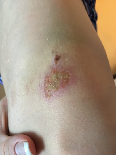 Scraped Knee Infection