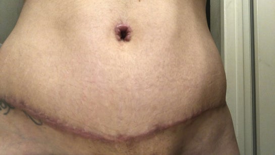 8 months post op. Hypertrophic scar after tummy tuck. What I can