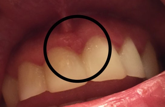 white spots on gums