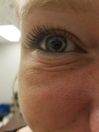 fine lines under eyes at 23