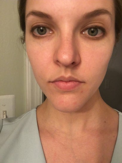 I Have Bulbous Cartilage On One Side Of My Nose What Is The Treatment Photo