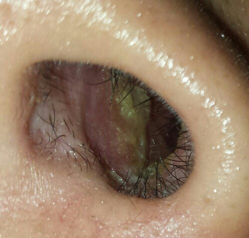 Scabs Inside Inside Of Nose Raw And Crusty