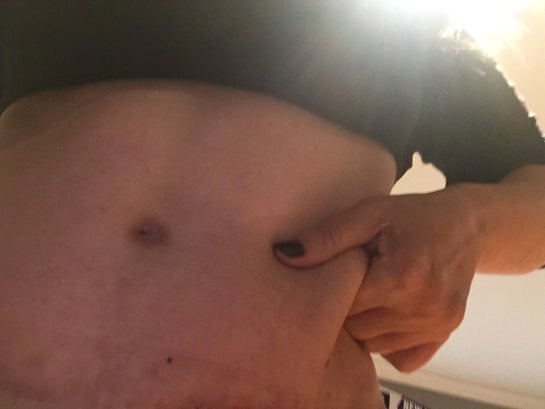 Belly button closed up after tummy tuck. I am still swollen or the