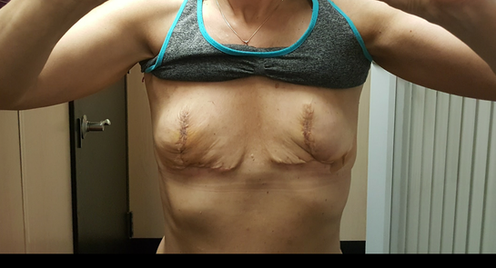 Should you have to cut off nipples then graph them back on in a breast  explant lift surgery? What's the correct way to do this?