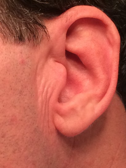 Wrinkles in front of ears. What s the best treament for a 50 year