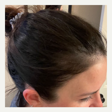 PRP for Hair Loss after 11756910 5017437