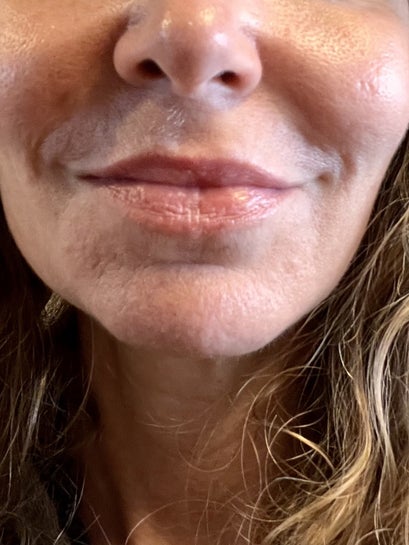 Candidate for lip lift Photo