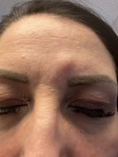 Hard lump still present MONTHS after Botox - what can I do? (photos)