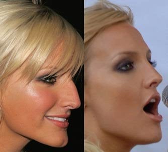 Non Surgical Rhinoplasty Possible On A Hook Nose non surgical rhinoplasty possible on a