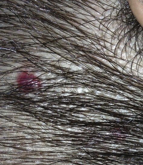 I Have A Red Mole On My Scalp And I M Worried Its Melanoma Photos