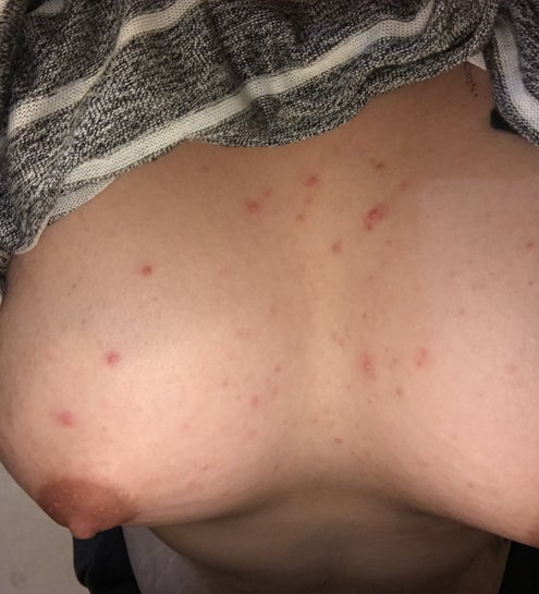 Symmastia 3 months post op? Surgeon says no but cleavage is scary