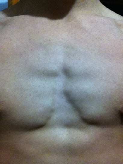 Chest Gap Cosmetic Surgery Please Help? (photo)